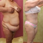 Tummy Tuck (Abdominoplasty) Super Plus Size Before & After Patient #13545