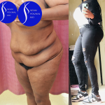 Tummy Tuck (Abdominoplasty) Plus Size Before & After Patient #13546