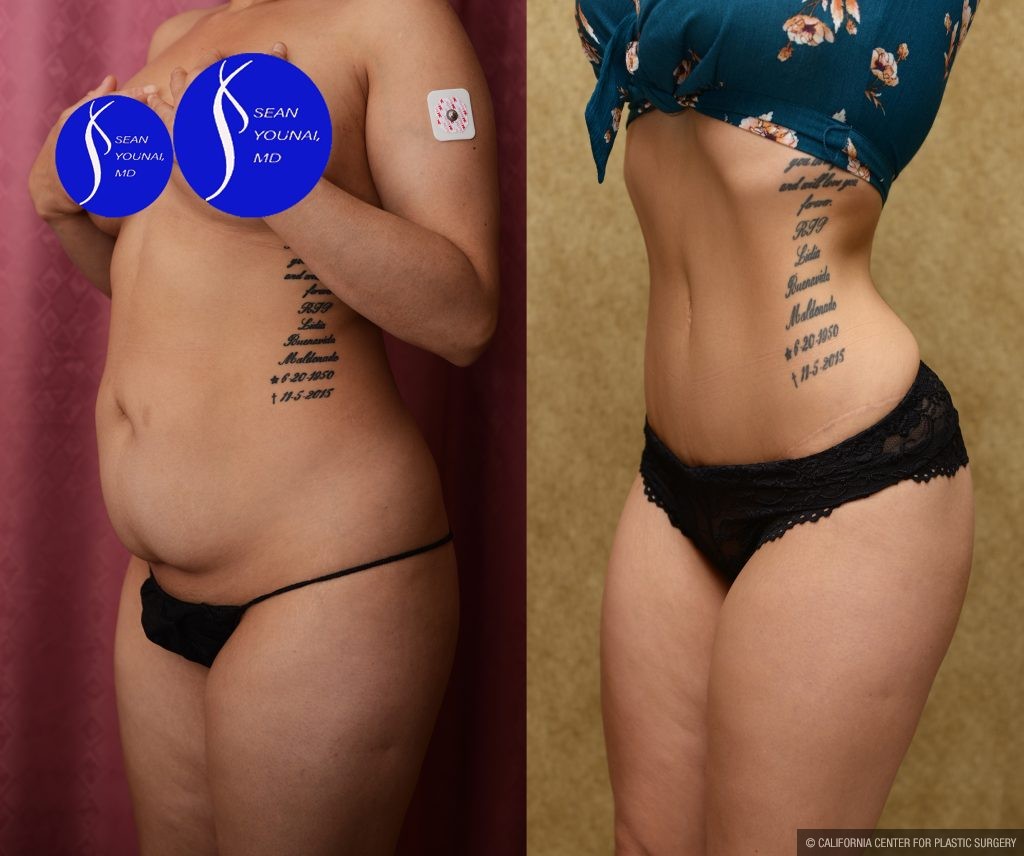 Tummy Tuck (Abdominoplasty) Small Size Before & After Patient #13562