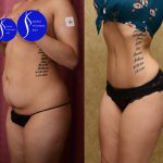 Tummy Tuck (Abdominoplasty) Small Size Before & After Patient #13562