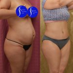Tummy Tuck (Abdominoplasty) Small Size Before & After Patient #13549