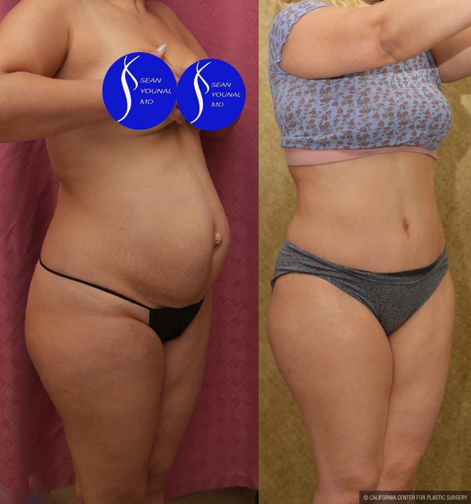 Tummy Tuck (Abdominoplasty) Small Size Before & After Patient #13549