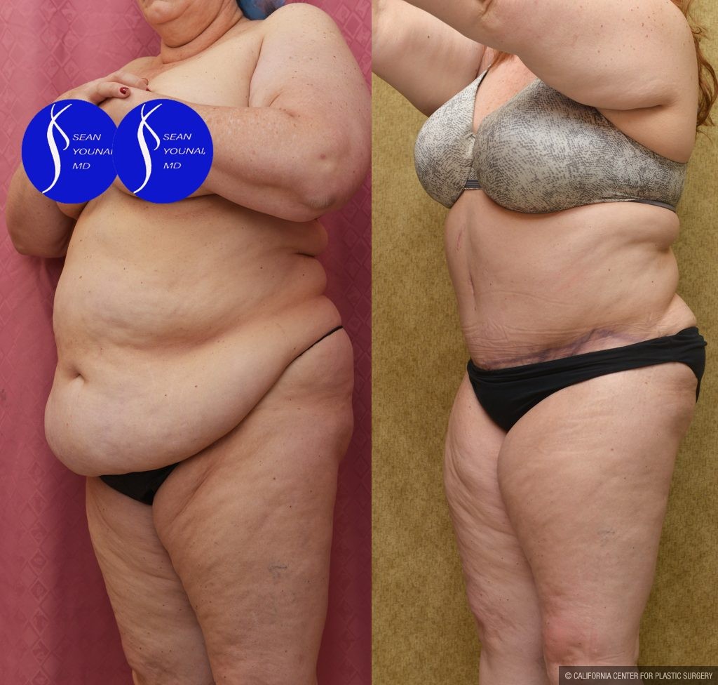 Tummy Tuck (Abdominoplasty) Plus Size Before & After Patient #13550
