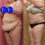 Tummy Tuck (Abdominoplasty) Plus Size Before & After Patient #13550