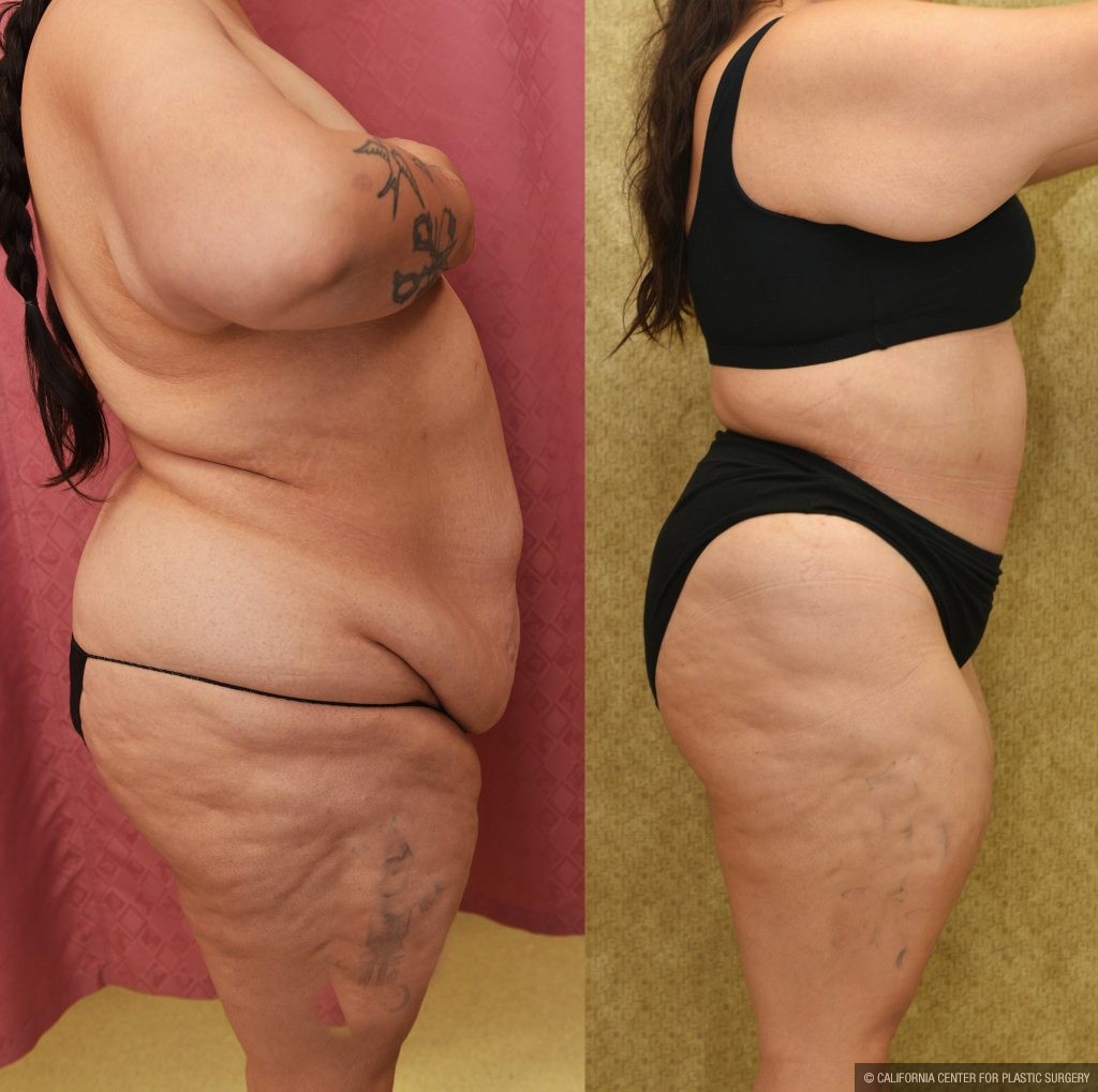 Tummy Tuck (Abdominoplasty) Plus Size Before & After Patient #13552