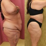 Tummy Tuck (Abdominoplasty) Plus Size Before & After Patient #13552