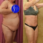 Tummy Tuck (Abdominoplasty) Medium Size Before & After Patient #13553