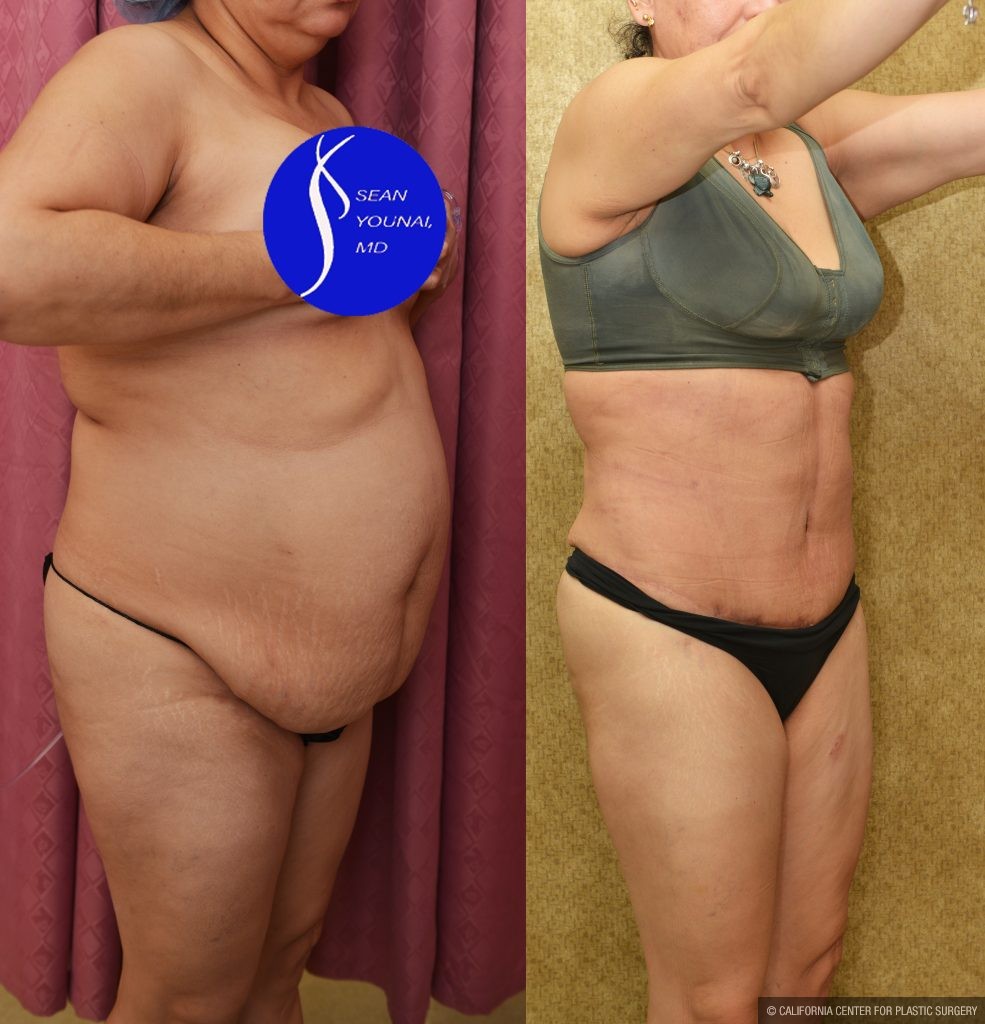 Tummy Tuck (Abdominoplasty) Medium Size Before & After Patient #13553