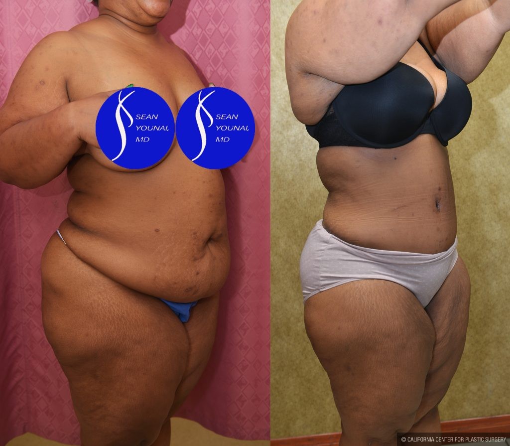 Tummy Tuck (Abdominoplasty) Plus Size Before & After Patient #13554