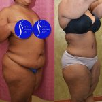 Tummy Tuck (Abdominoplasty) Plus Size Before & After Patient #13554