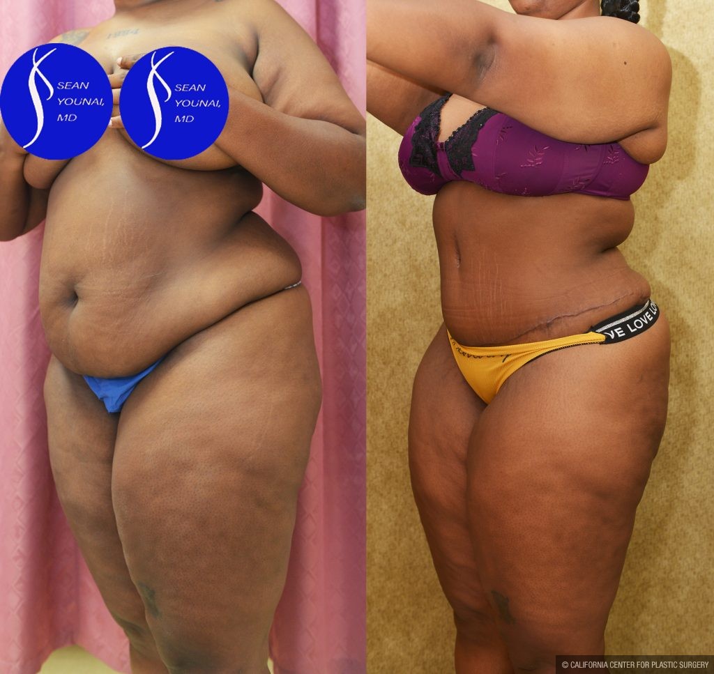 African American Tummy Tuck (Abdominoplasty) Before & After Patient #13555
