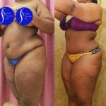 African American Tummy Tuck (Abdominoplasty) Before & After Patient #13555