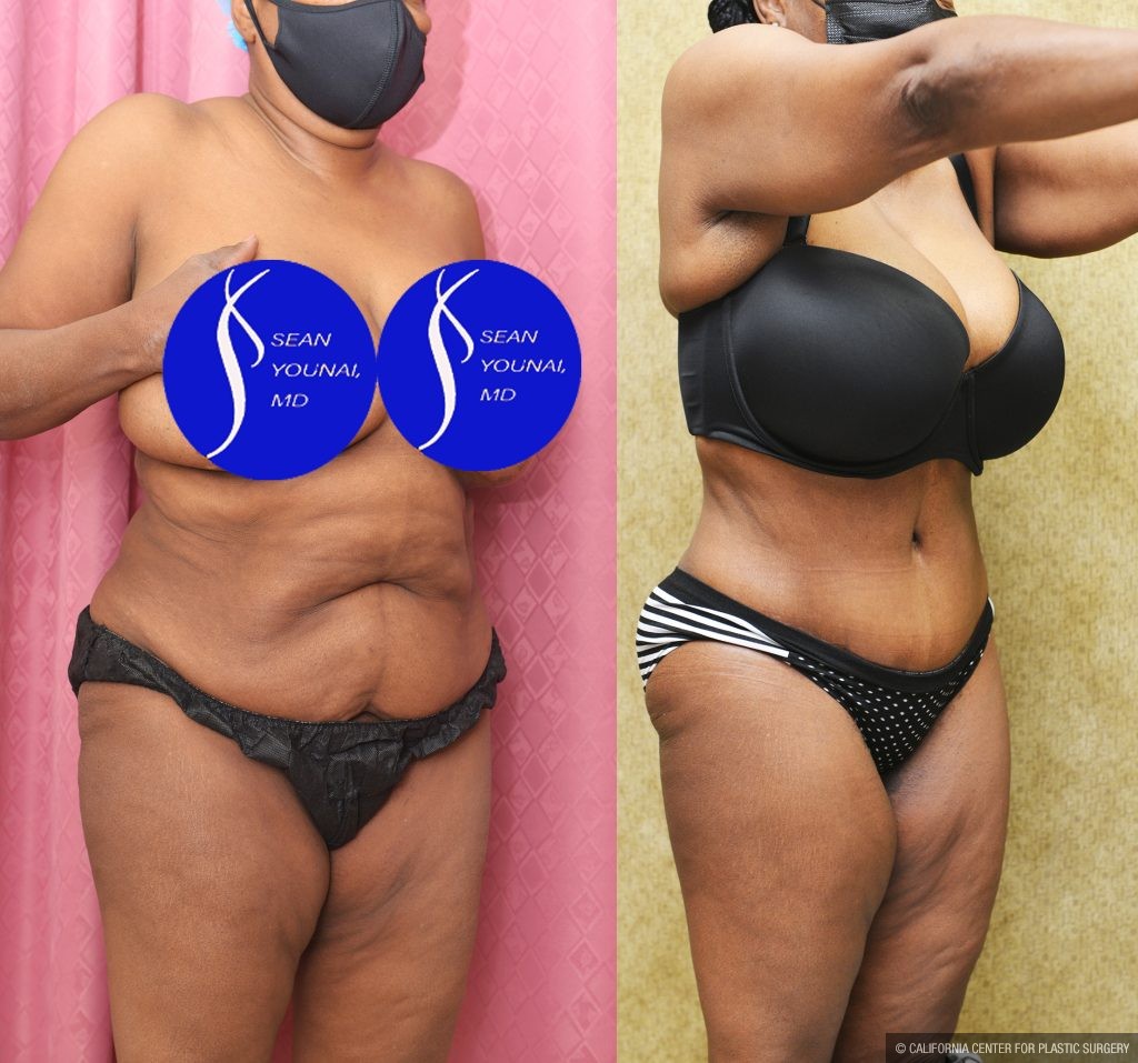 African American Tummy Tuck (Abdominoplasty) Before & After Patient #13556