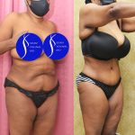 African American Tummy Tuck (Abdominoplasty) Before & After Patient #13556