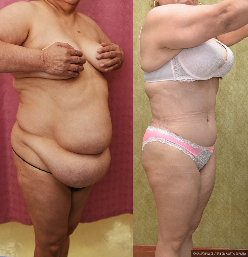 Tummy Tuck (Abdominoplasty) Super Plus Size Before & After Patient #13545