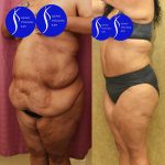 Tummy Tuck (Abdominoplasty) Super Plus Size Before & After Patient #13547