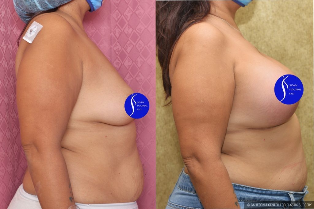 Breast Lift - Full Before & After Patient #13557