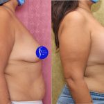 Breast Lift - Full Before & After Patient #13557