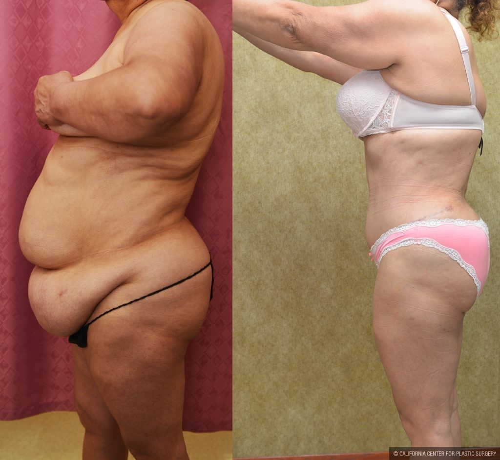 Tummy Tuck (Abdominoplasty) Super Plus Size Before & After Patient #13545