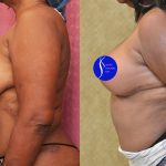 Breast Lift - Full Before & After Patient #13558