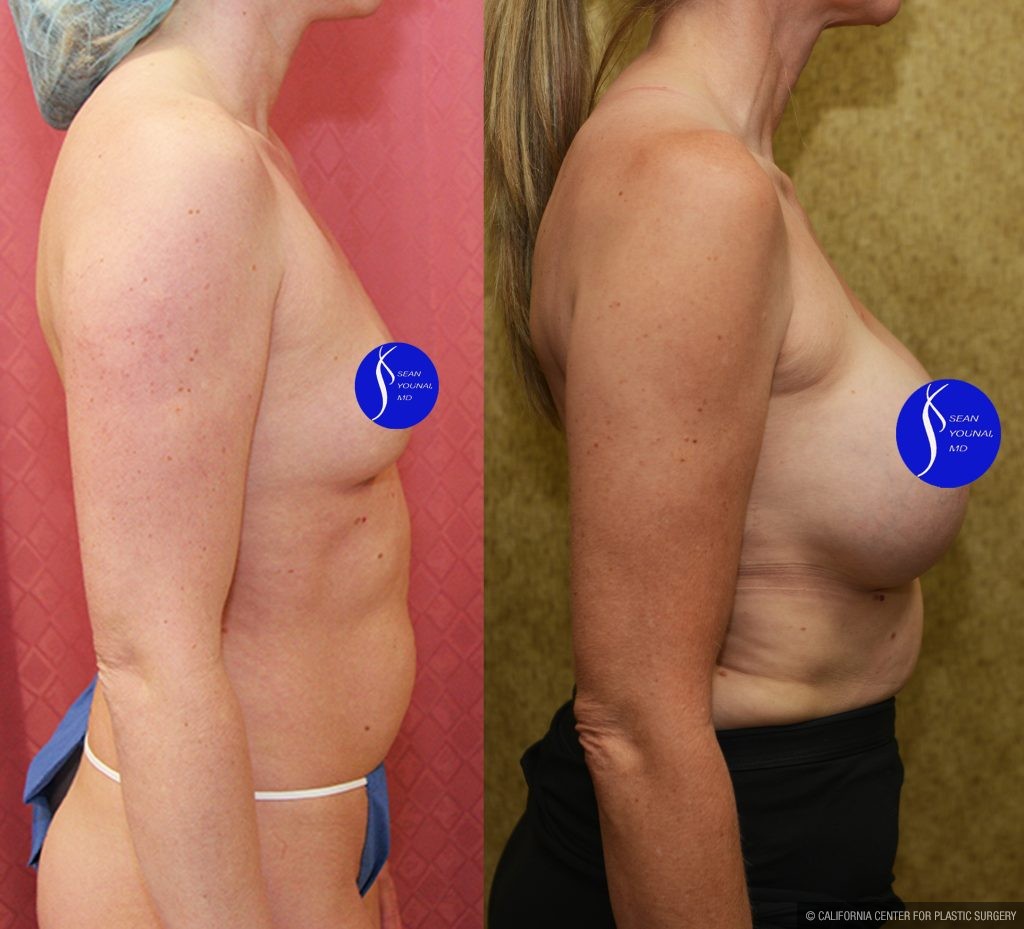 Breast Augmentation Before & After Patient #13559