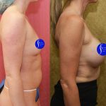 Breast Augmentation Before & After Patient #13559