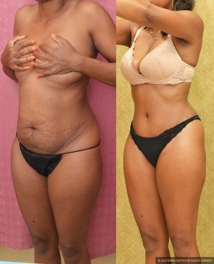 Tummy Tuck (Abdominoplasty) Small Size Before & After Patient #13560