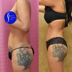 Tummy Tuck (Abdominoplasty) Small Size Before & After Patient #13561