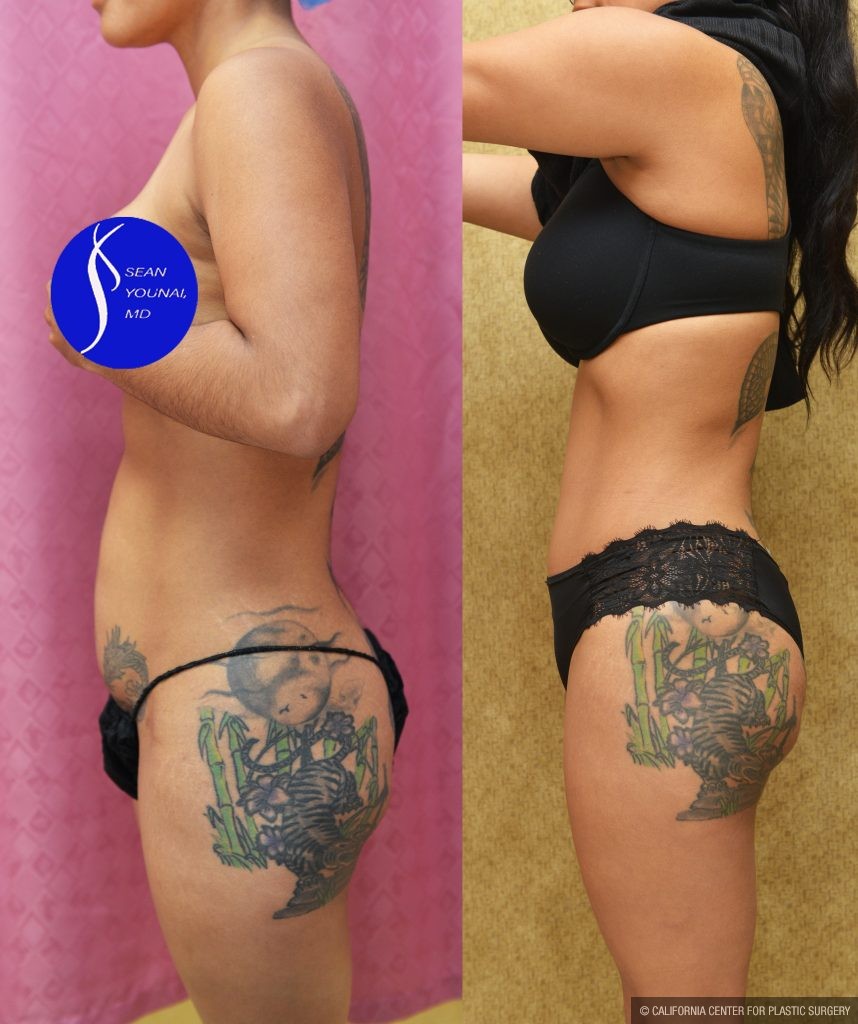 Tummy Tuck (Abdominoplasty) Small Size Before & After Patient #13561