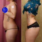 Tummy Tuck (Abdominoplasty) Small Size Before & After Patient #13562