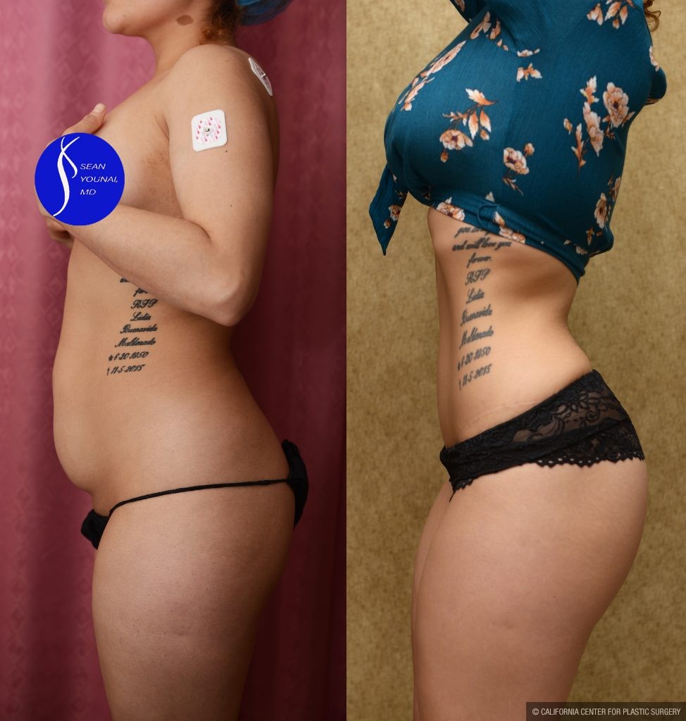 Tummy Tuck (Abdominoplasty) Small Size Before & After Patient #13562