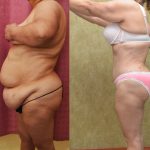 Tummy Tuck (Abdominoplasty) Super Plus Size Before & After Patient #13545