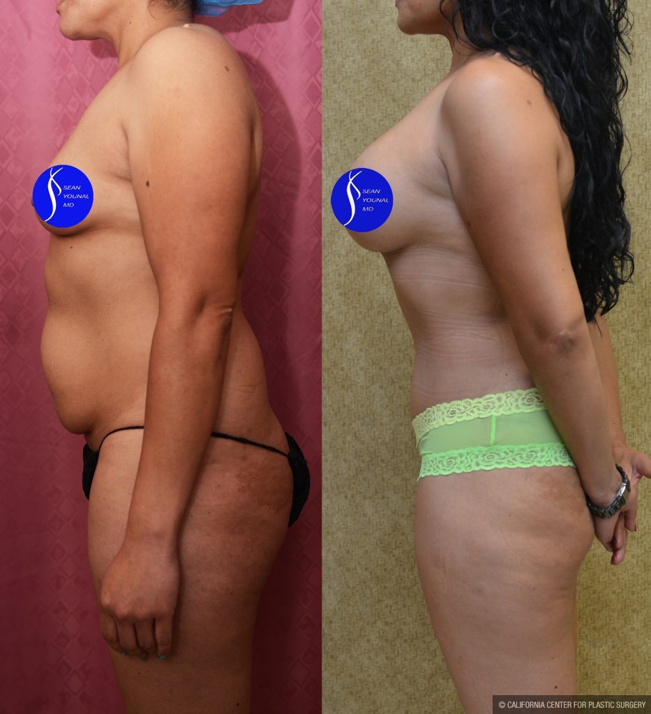 Mommy Makeover Before & After Patient #13563