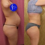 Tummy Tuck (Abdominoplasty) Small Size Before & After Patient #13549