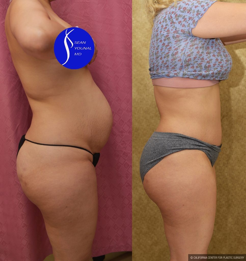 Tummy Tuck (Abdominoplasty) Small Size Before & After Patient #13549