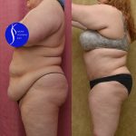 Tummy Tuck (Abdominoplasty) Plus Size Before & After Patient #13550