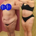 Tummy Tuck (Abdominoplasty) Plus Size Before & After Patient #13552