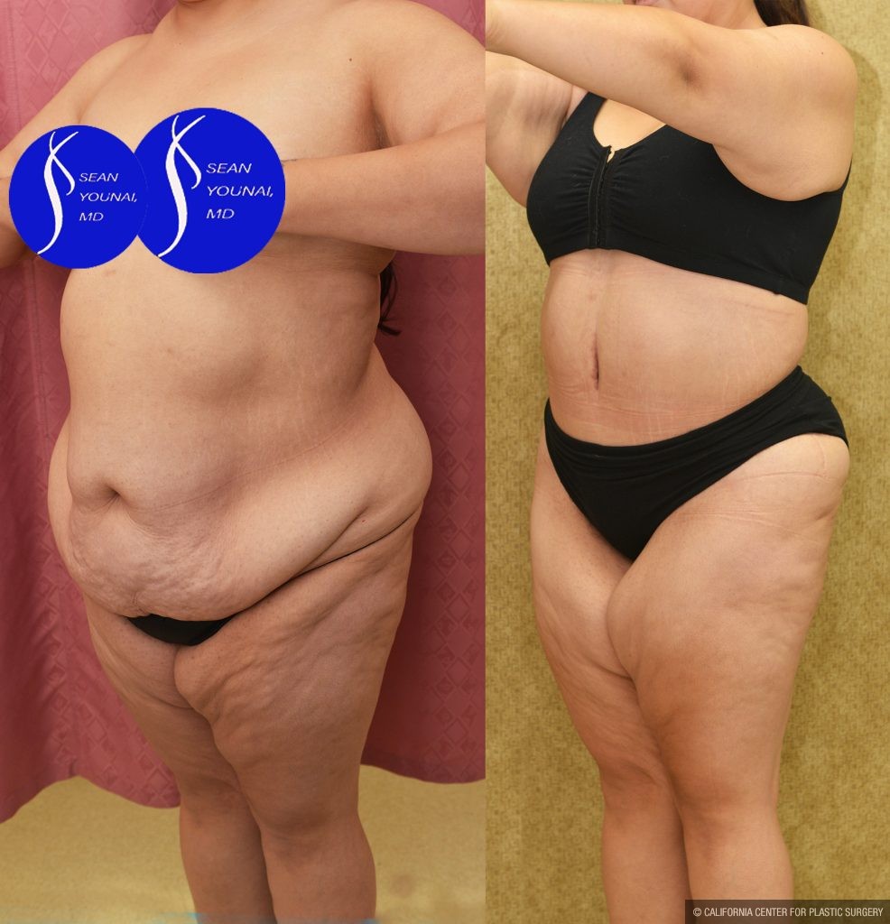 Tummy Tuck (Abdominoplasty) Plus Size Before & After Patient #13552