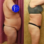 Tummy Tuck (Abdominoplasty) Medium Size Before & After Patient #13553