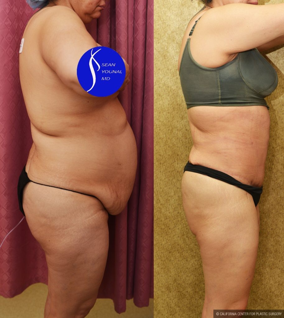 Tummy Tuck (Abdominoplasty) Medium Size Before & After Patient #13553