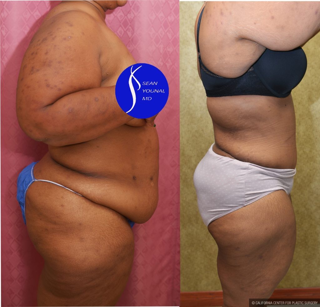 Tummy Tuck (Abdominoplasty) Plus Size Before & After Patient #13554