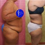 Tummy Tuck (Abdominoplasty) Plus Size Before & After Patient #13554