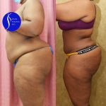African American Tummy Tuck (Abdominoplasty) Before & After Patient #13555