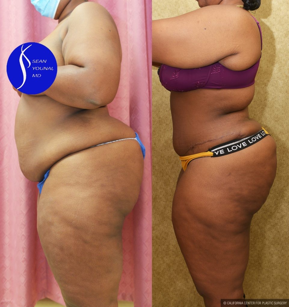African American Tummy Tuck (Abdominoplasty) Before & After Patient #13555