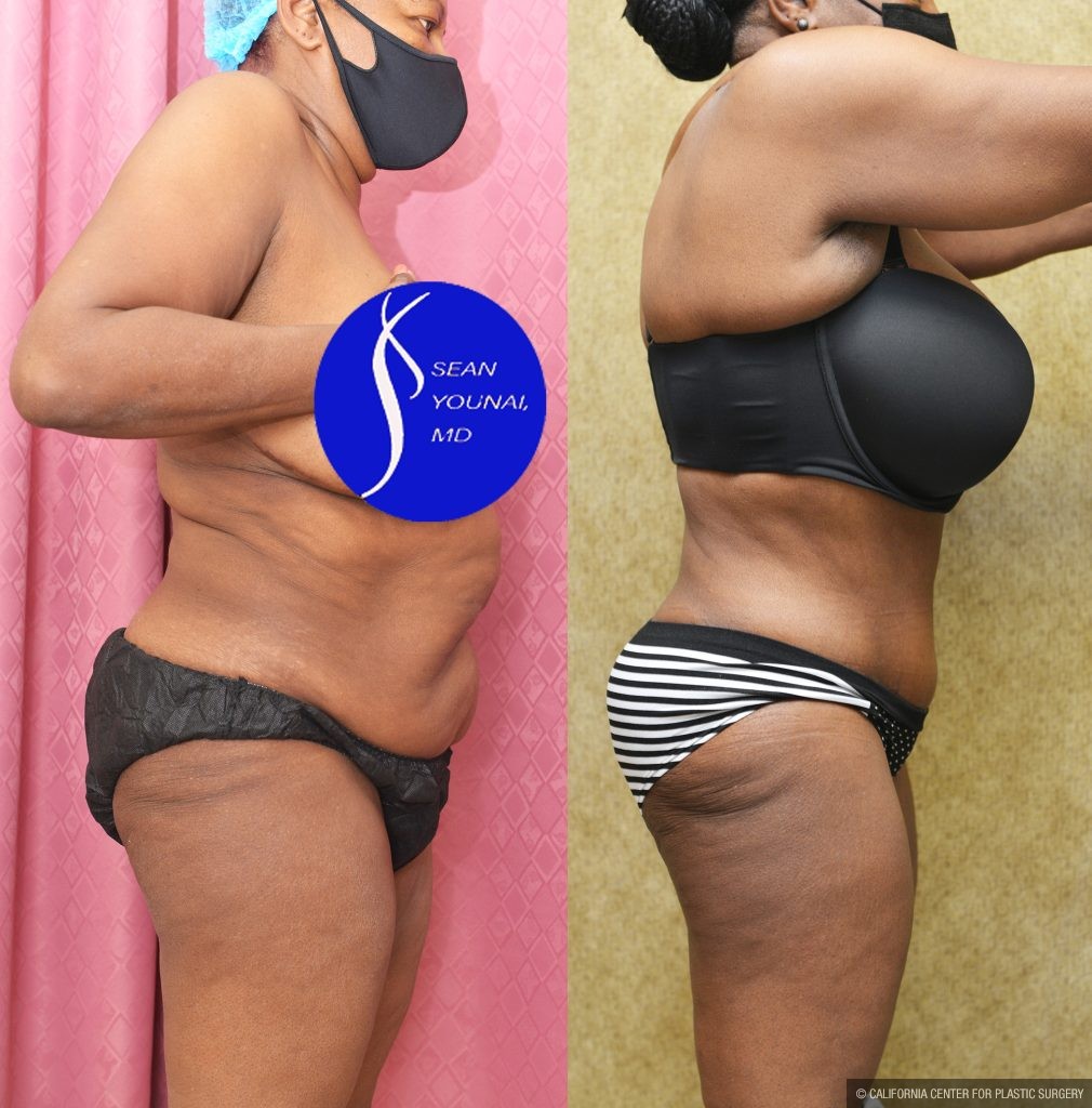 African American Tummy Tuck (Abdominoplasty) Before & After Patient #13556