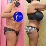 African American Tummy Tuck (Abdominoplasty) Before & After Patient #13556
