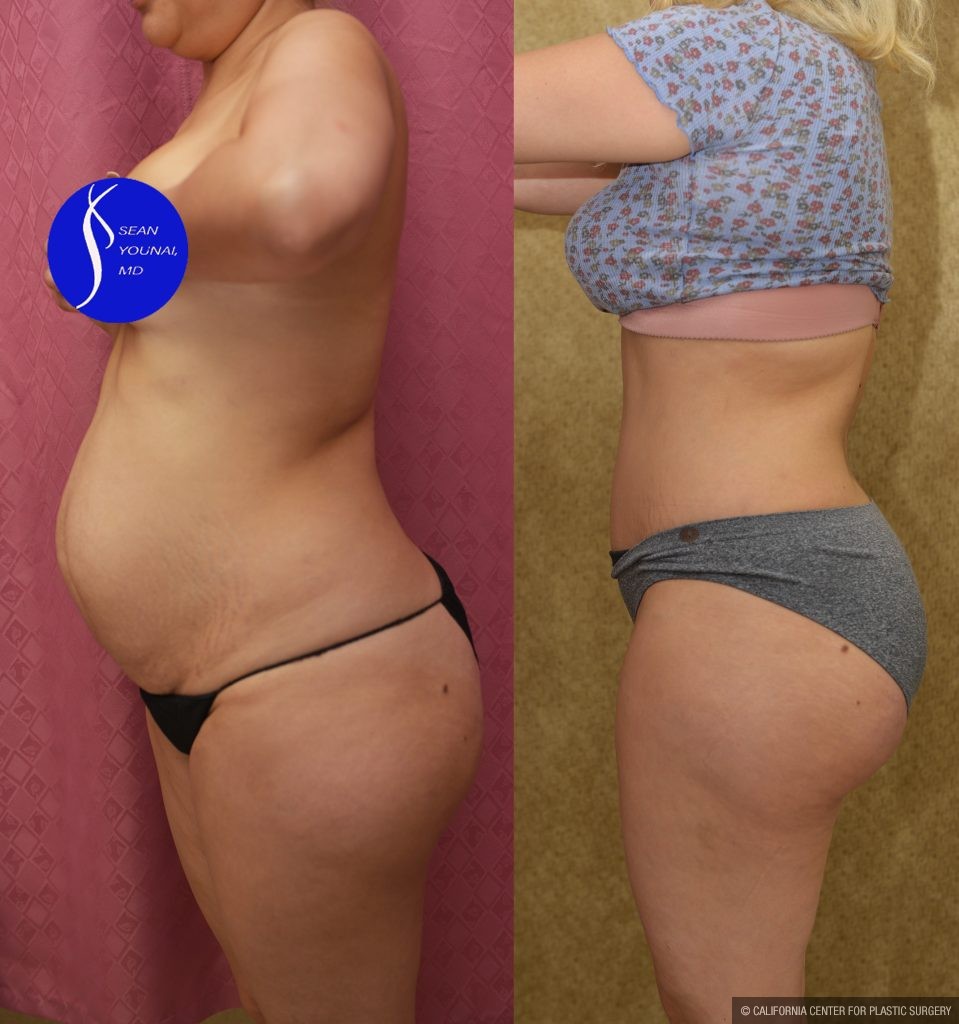 Tummy Tuck (Abdominoplasty) Small Size Before & After Patient #13549