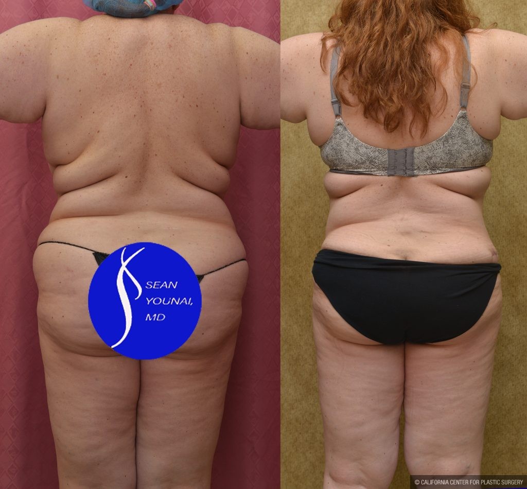 Tummy Tuck (Abdominoplasty) Plus Size Before & After Patient #13550