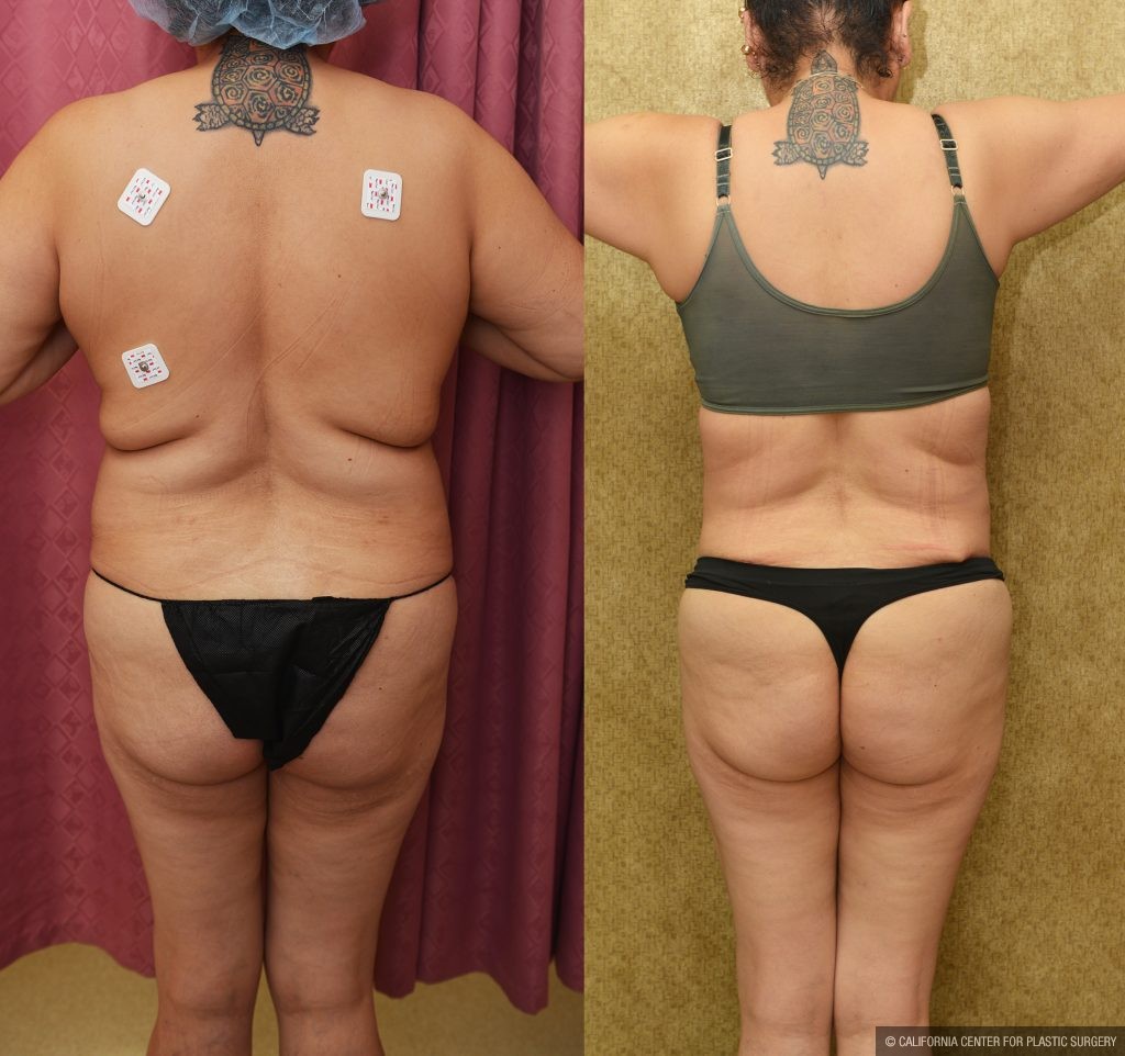 Tummy Tuck (Abdominoplasty) Medium Size Before & After Patient #13553