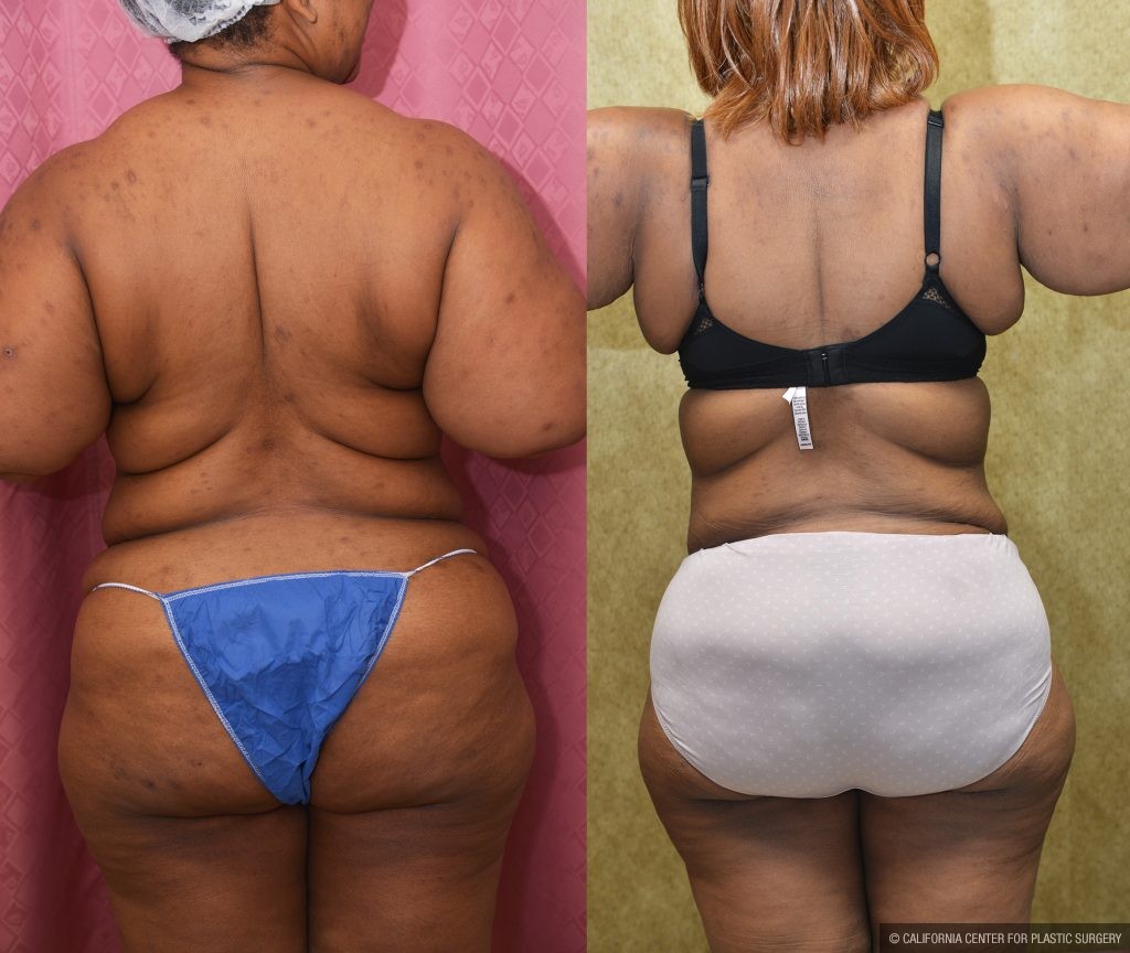 Tummy Tuck (Abdominoplasty) Plus Size Before & After Patient #13554